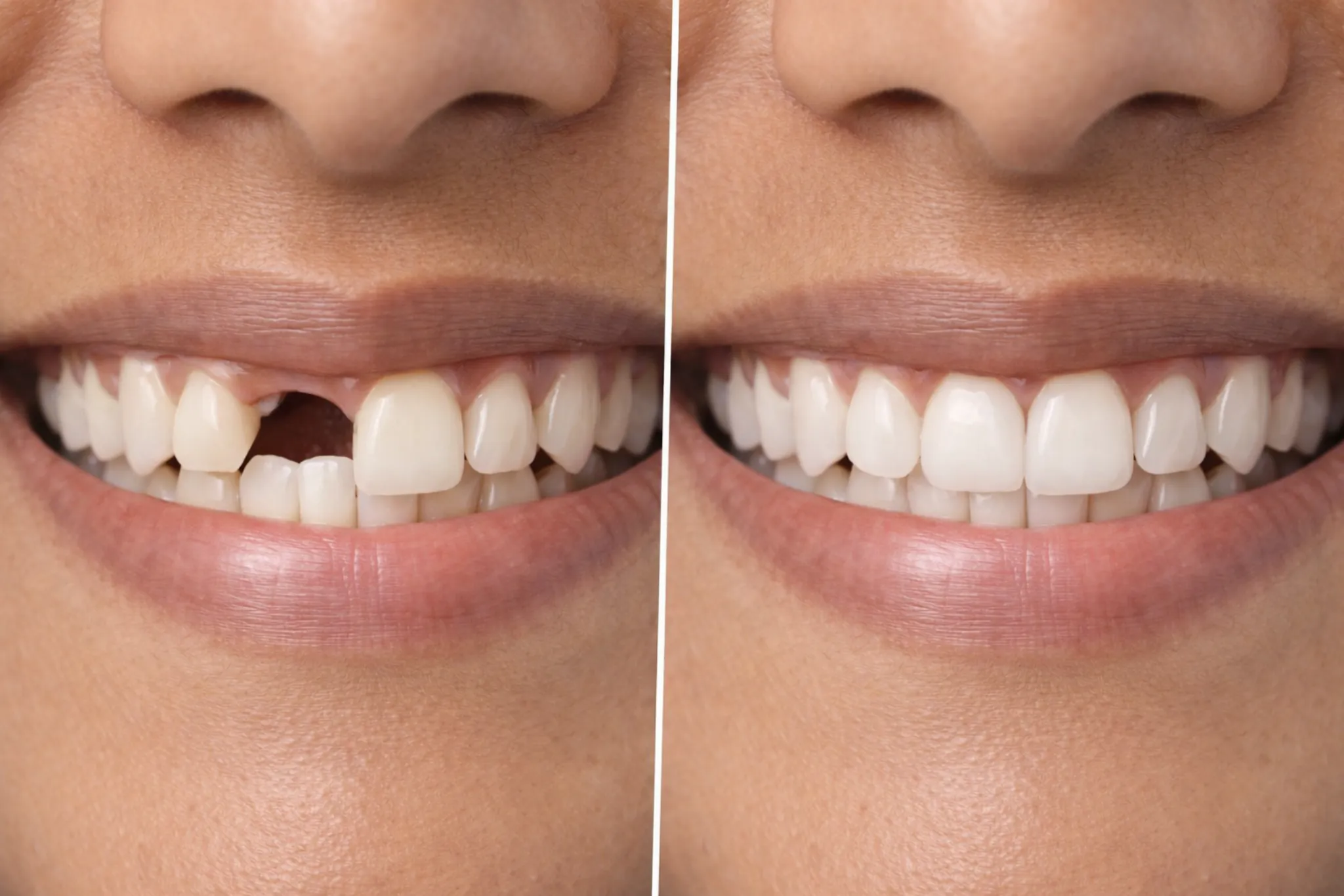 Dental Implant Smile